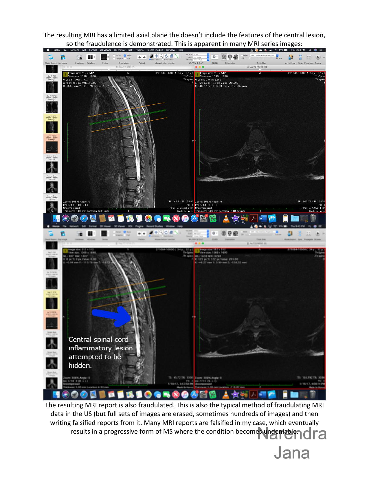 Falsified Discharge Summary