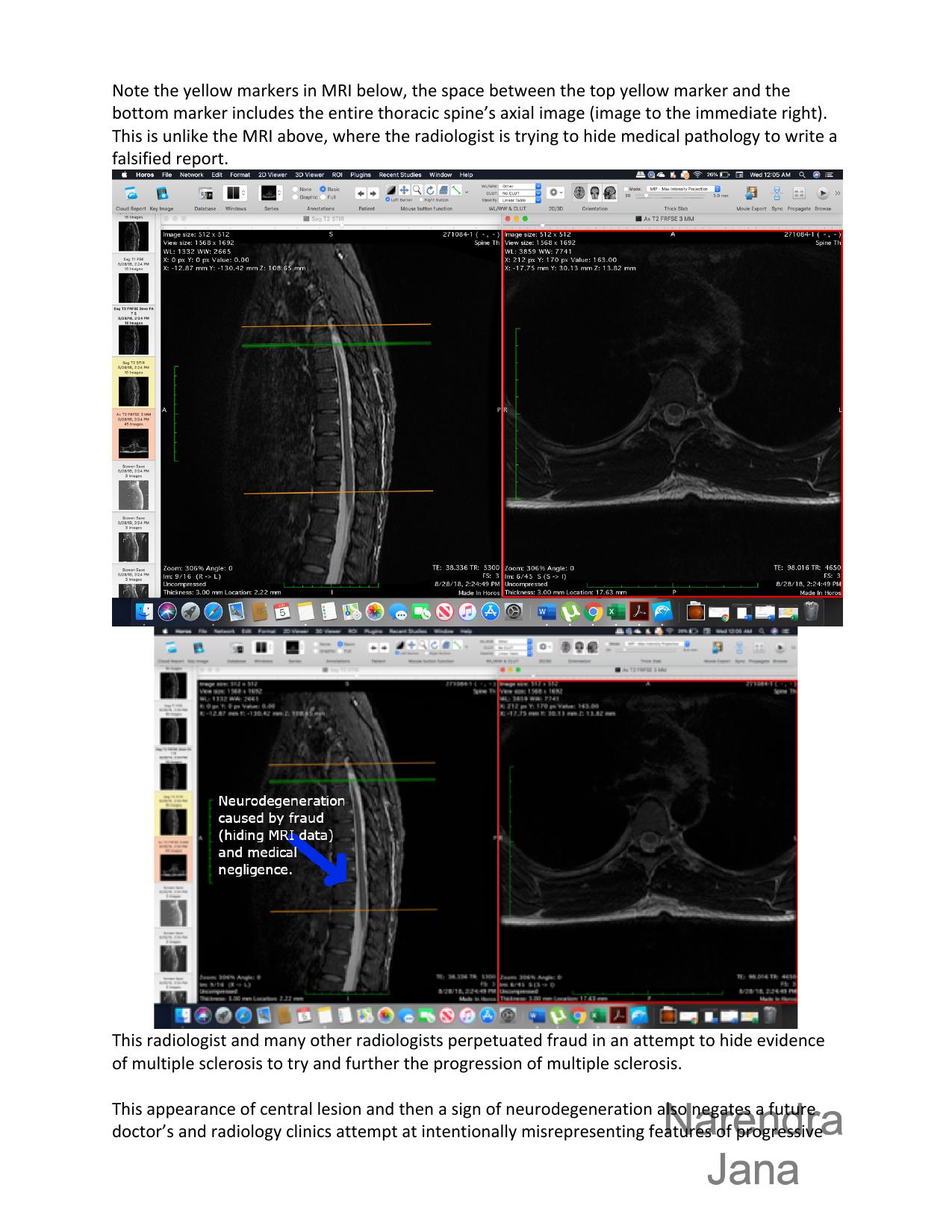 Falsified Discharge Summary